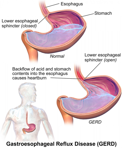  gastroesophageal reflux illness chart. According to a recent study, around 20% of Americans suffer from this disease. The effects of it usually take place at least twice or thrice a week. If you are one of the 20% who is suffering from gastroesophageal reflux disease, then be sure to seek the help or assistance of an online therapist. At this point, you have to understand the fact that it medical therapy is a great necessity.